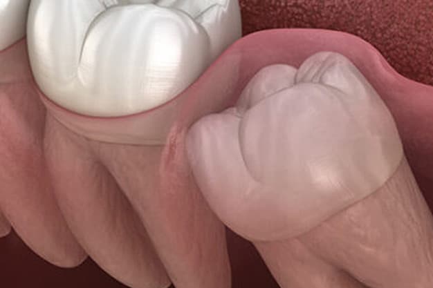 รักษารากฟัน